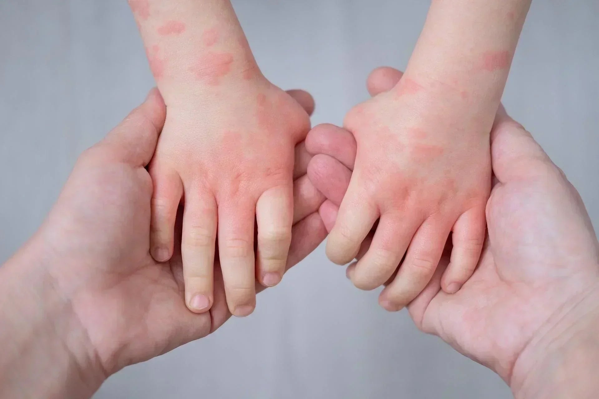 The Link Between Eczema and Gut Health: What You Need to Know