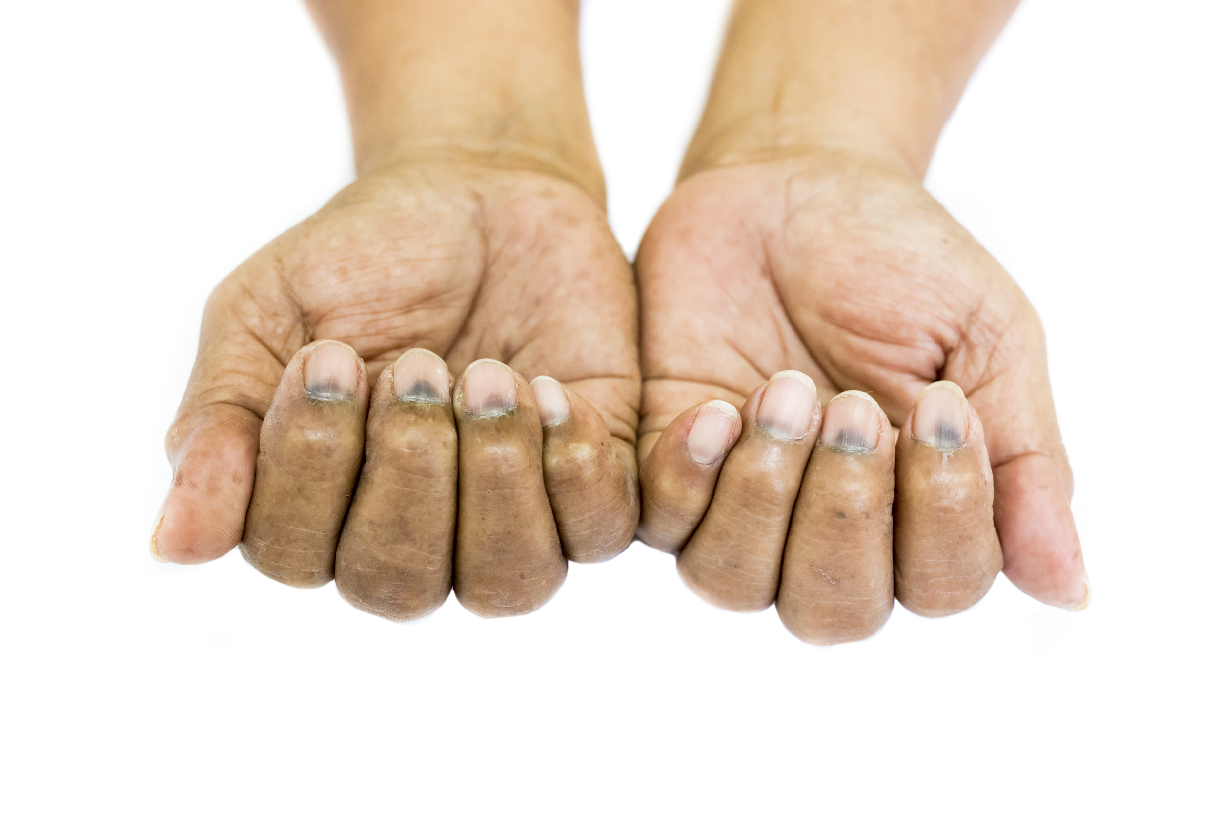 Beyond Hair Loss: Skin Dermatitis During Cancer Treatment — Causes, Treatments, and Prevention