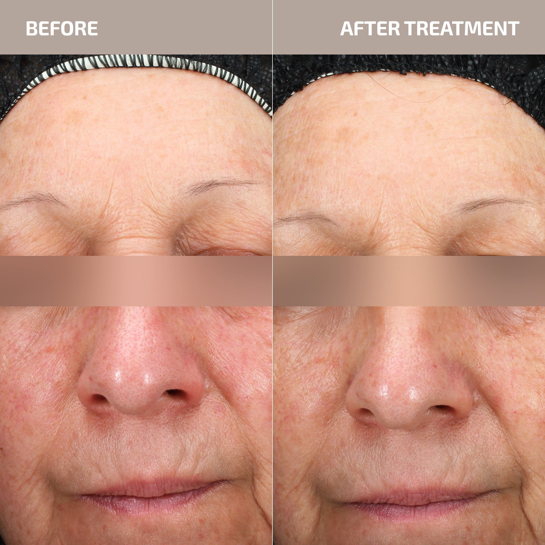 Antu Skin Longevity Protocol - Skin Barrier L-histidine supplement & M3 Antioxidant Serum (Age: 30-60+)