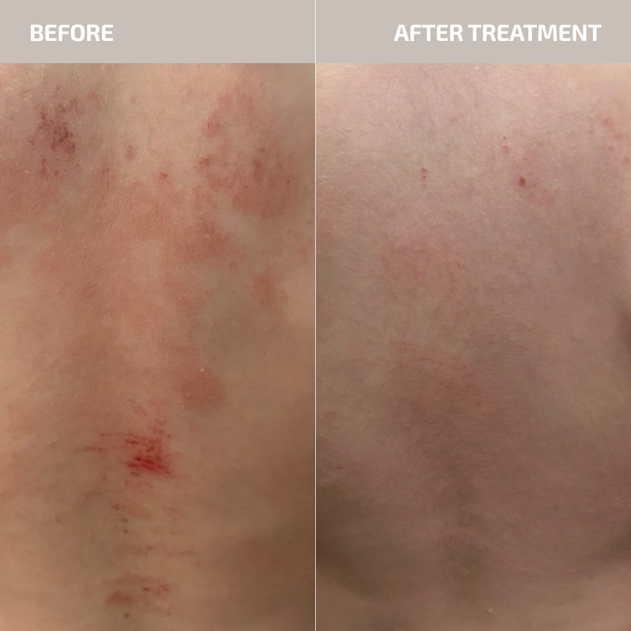 Skin Barrier Repair Supplement for Dry & Sensitive Skin – ANTU Powder Sachets