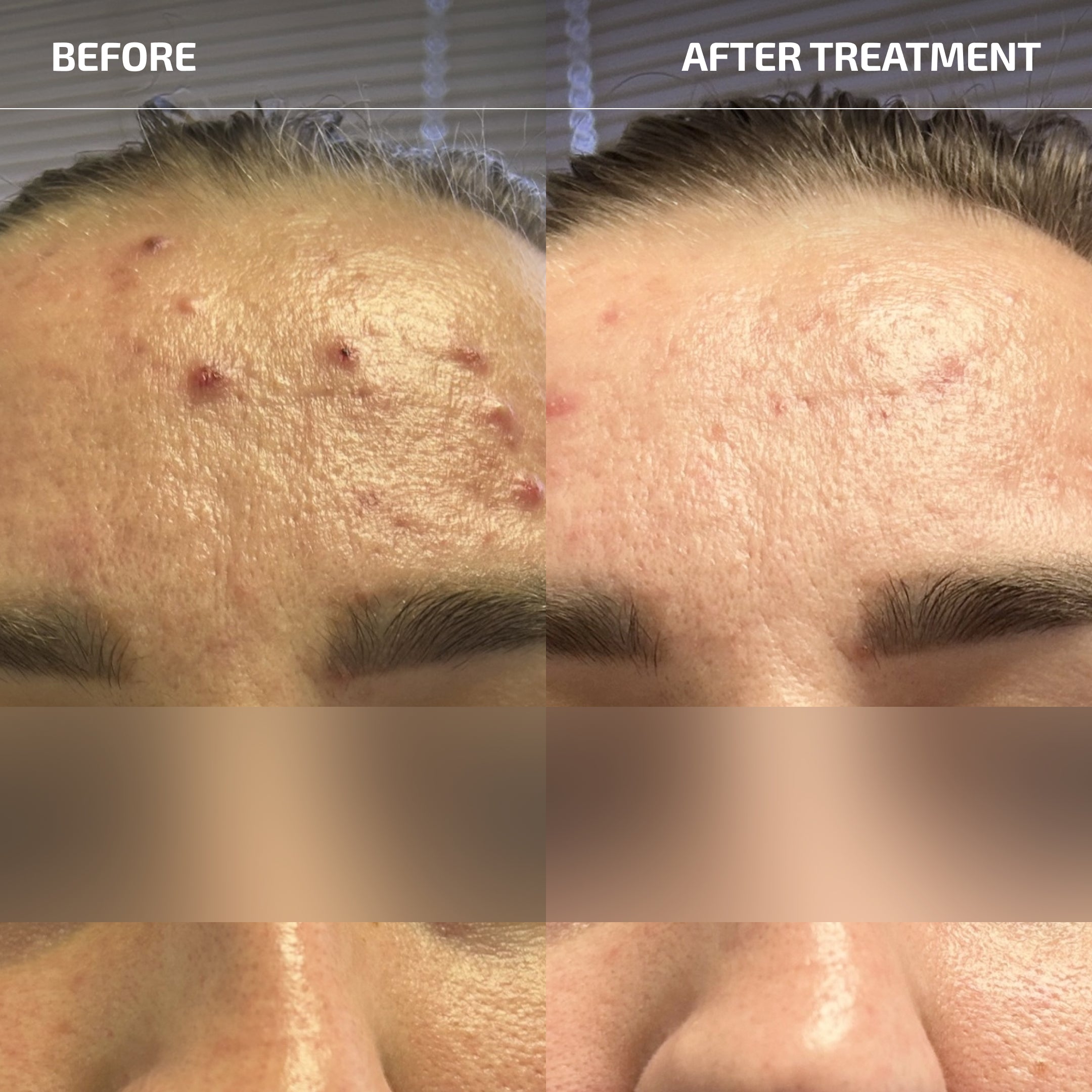 Complete Acne Treatment System – Full Clear Skin Routine with Probiotic (60-DAY, 18+)