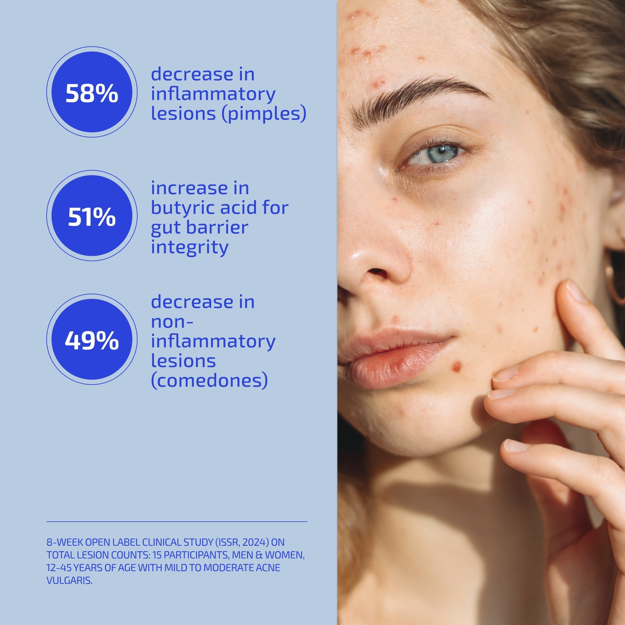 Complete Acne Treatment System – Full Clear Skin Routine with Probiotic (60-DAY, 18+)