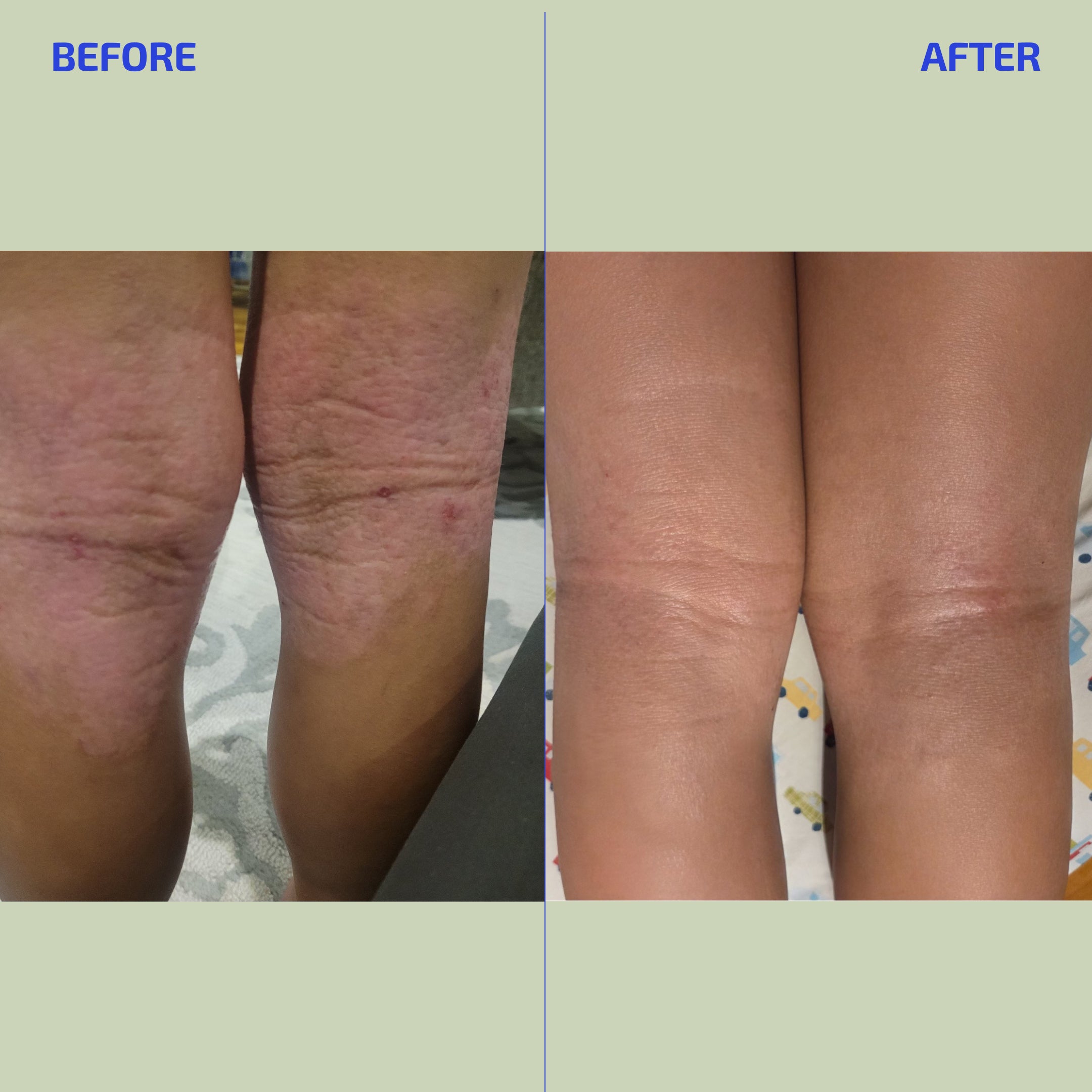 Eczema Relief Lotion for Dry, Itchy & Sensitive Skin – BIA (Age: 3+ months)