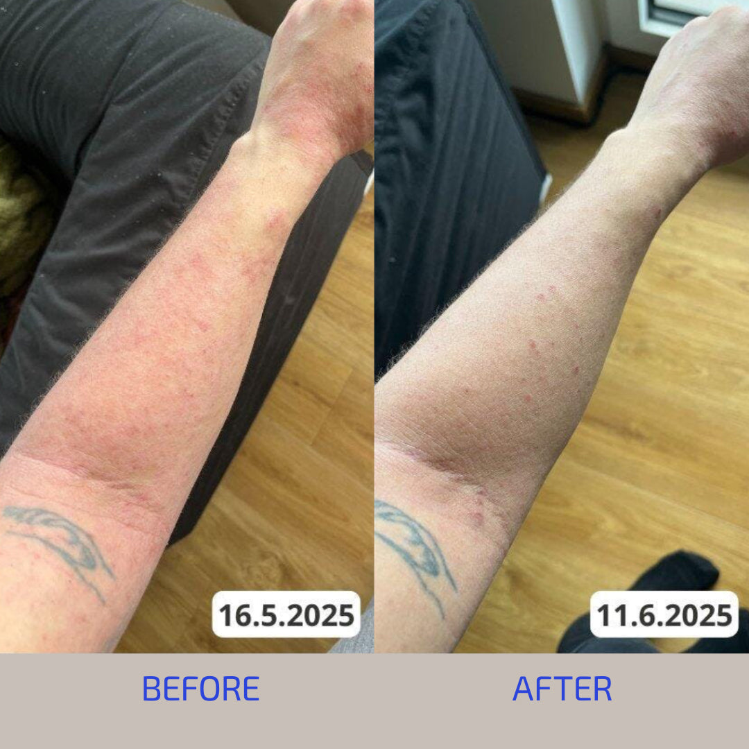 Skin Barrier Eczema-Prone Relief System (Adult: 18+)