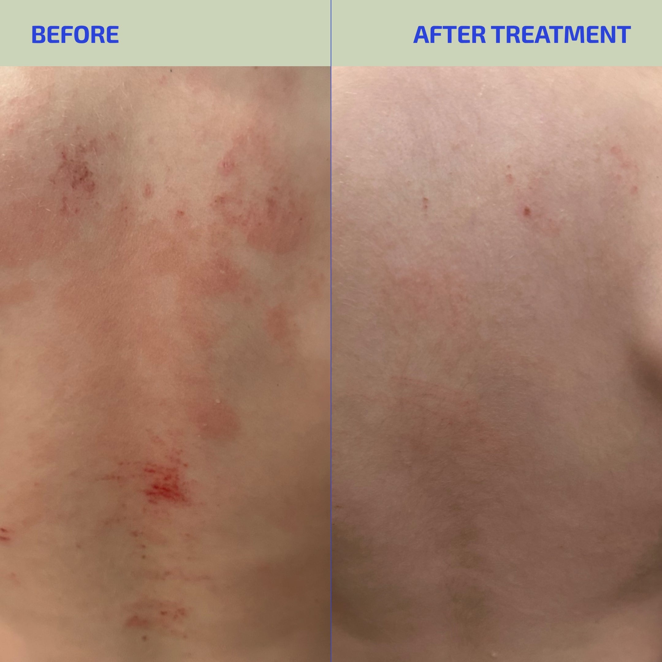 Clear Skin Synbiotic Supplement for Eczema-Prone Skin – 30 Capsules (Age: 12+)