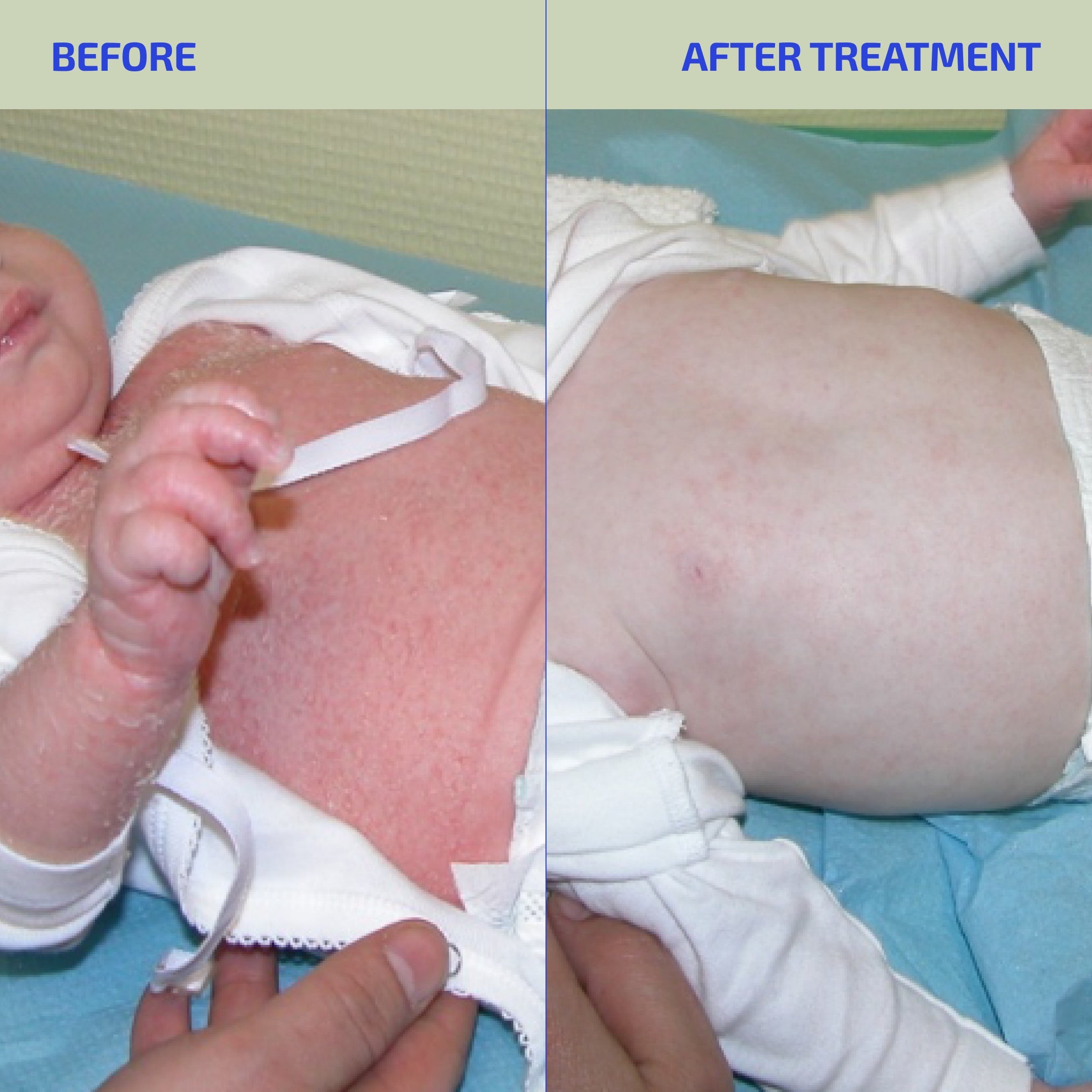 Before and after treatment comparison of a baby's skin condition.