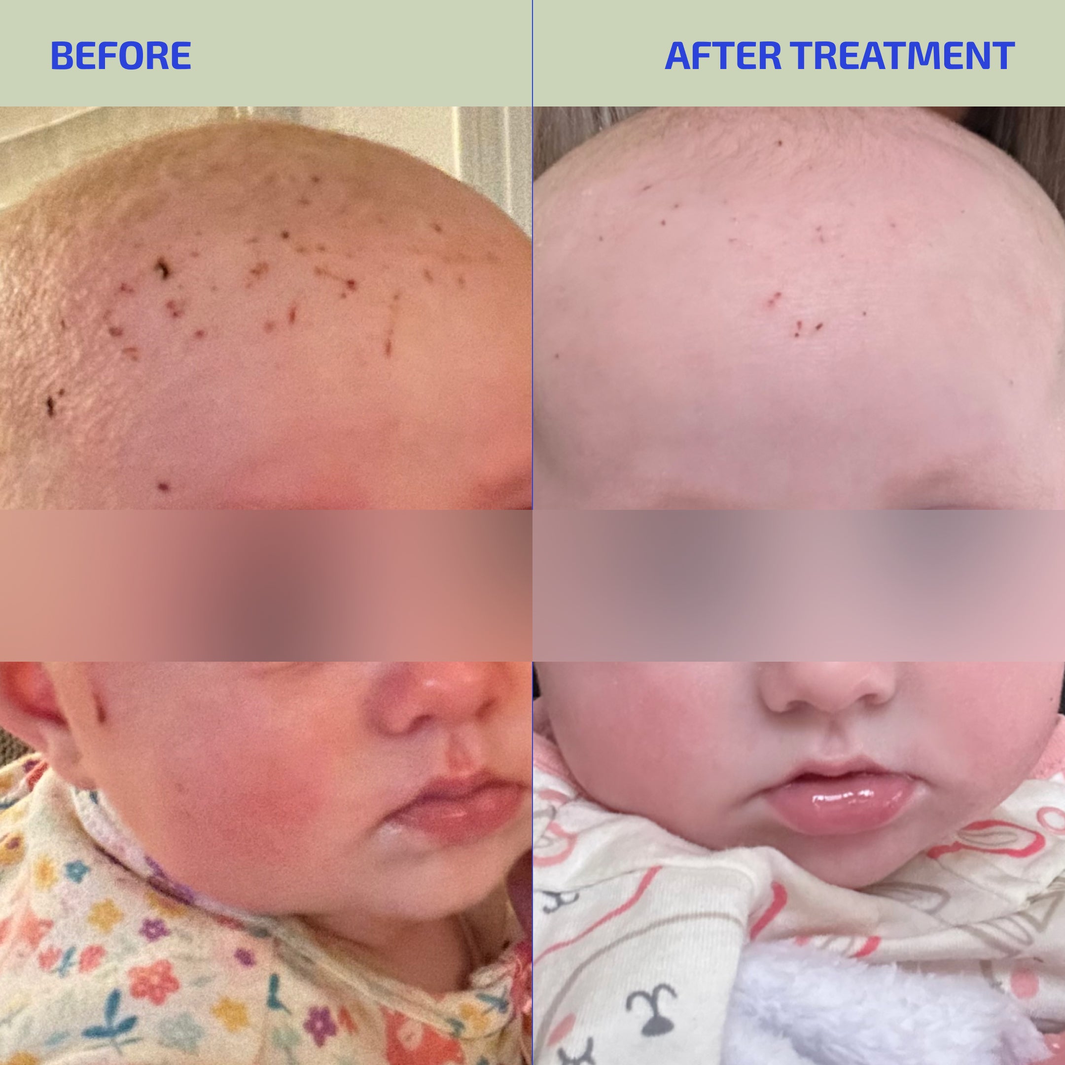 Skin Barrier Eczema-Prone Relief System (Infant: 3-12 months)