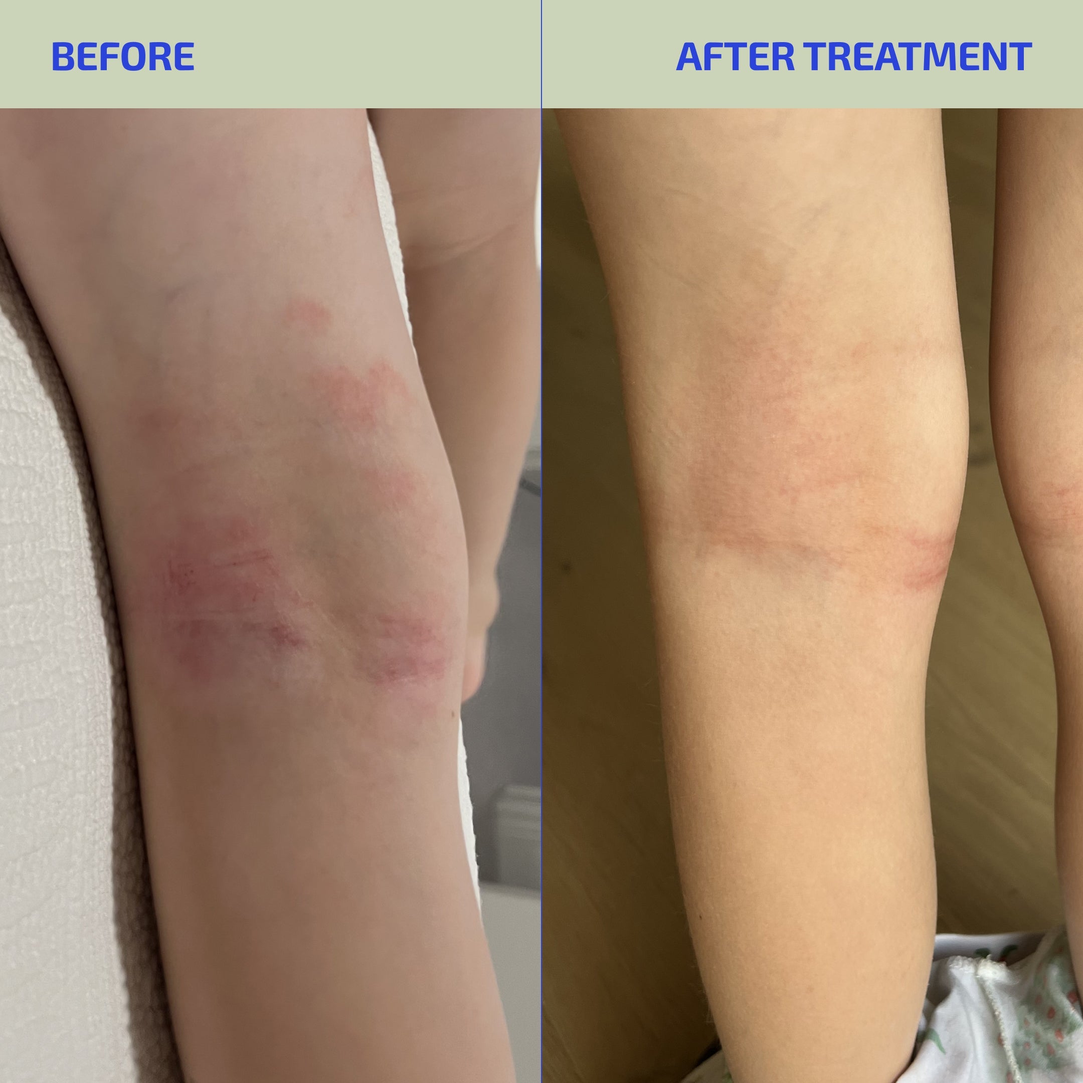Before and after treatment comparison of a person's leg with visible skin condition.