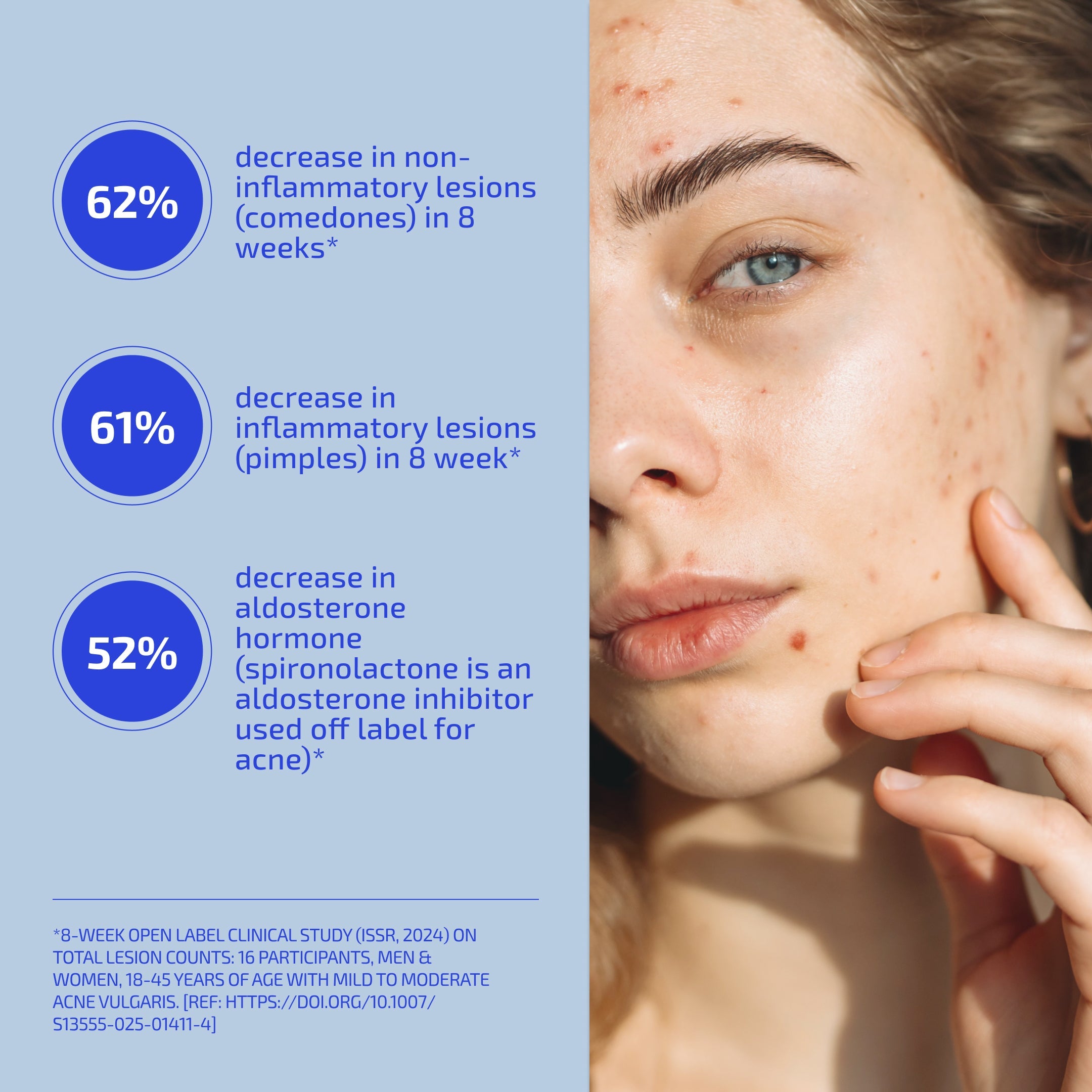 SHAANT Skin De-Stress Supplement 2.0 for Hormonal Acne